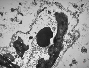 M, | dystrophic calcification and malaric pigment - brain M, | dystrophic calcification and malaric pigment - brain